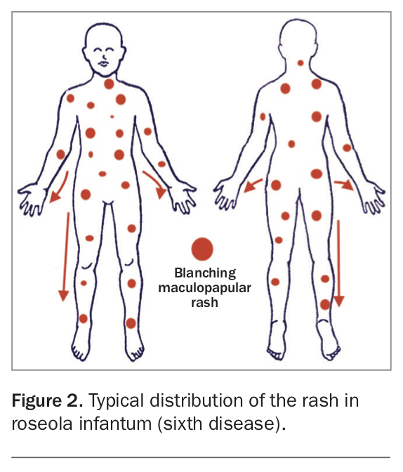 Viral Exanthem Chart National Guidance For The Management Of Children